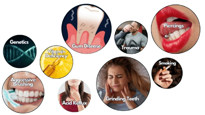 Causes Behind Receding Gums