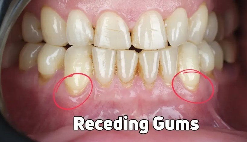 Receding Gums