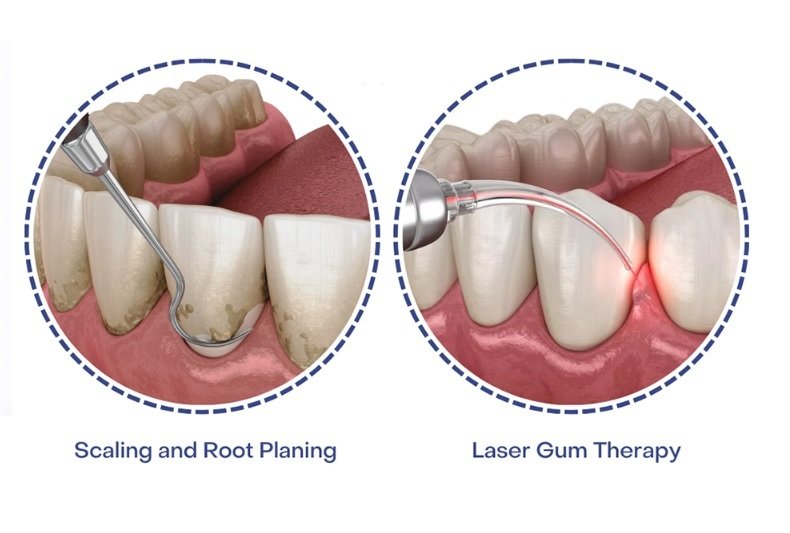 non-surgical receding gums treatments
