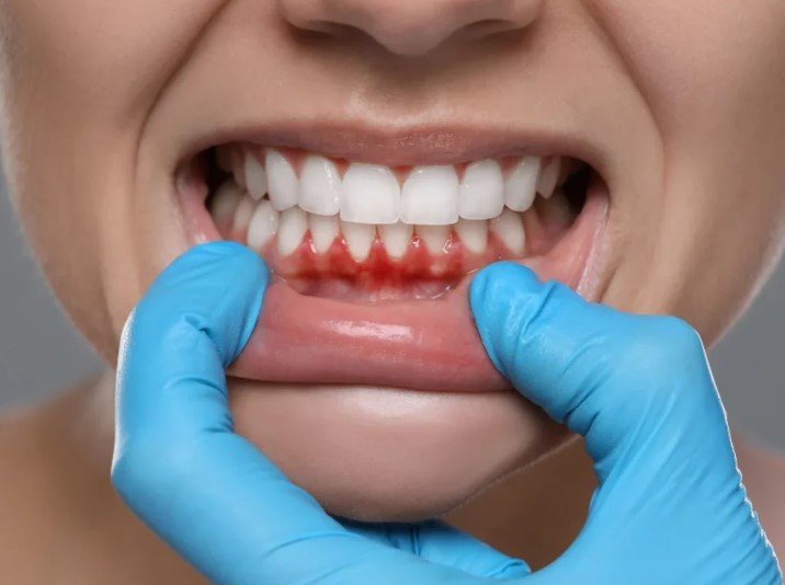 receding gums treatment at home vs dentist cost